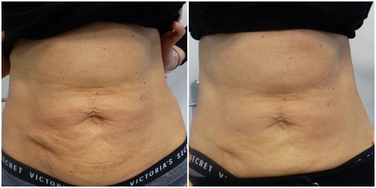 Trattamento Radiofrequenza Thuzzle per riduzione grasso localizzato/adiposità addome e tonificazione del corpo