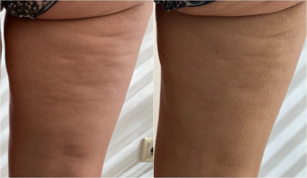Trattamento di radiofrequenza Thuzzle per la riduzione della cellulite e tonificazione delle gambe