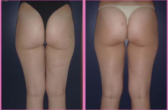 Trattamento di radiofrequenza Thuzzle per la riduzione della cellulite e tonificazione delle gambe