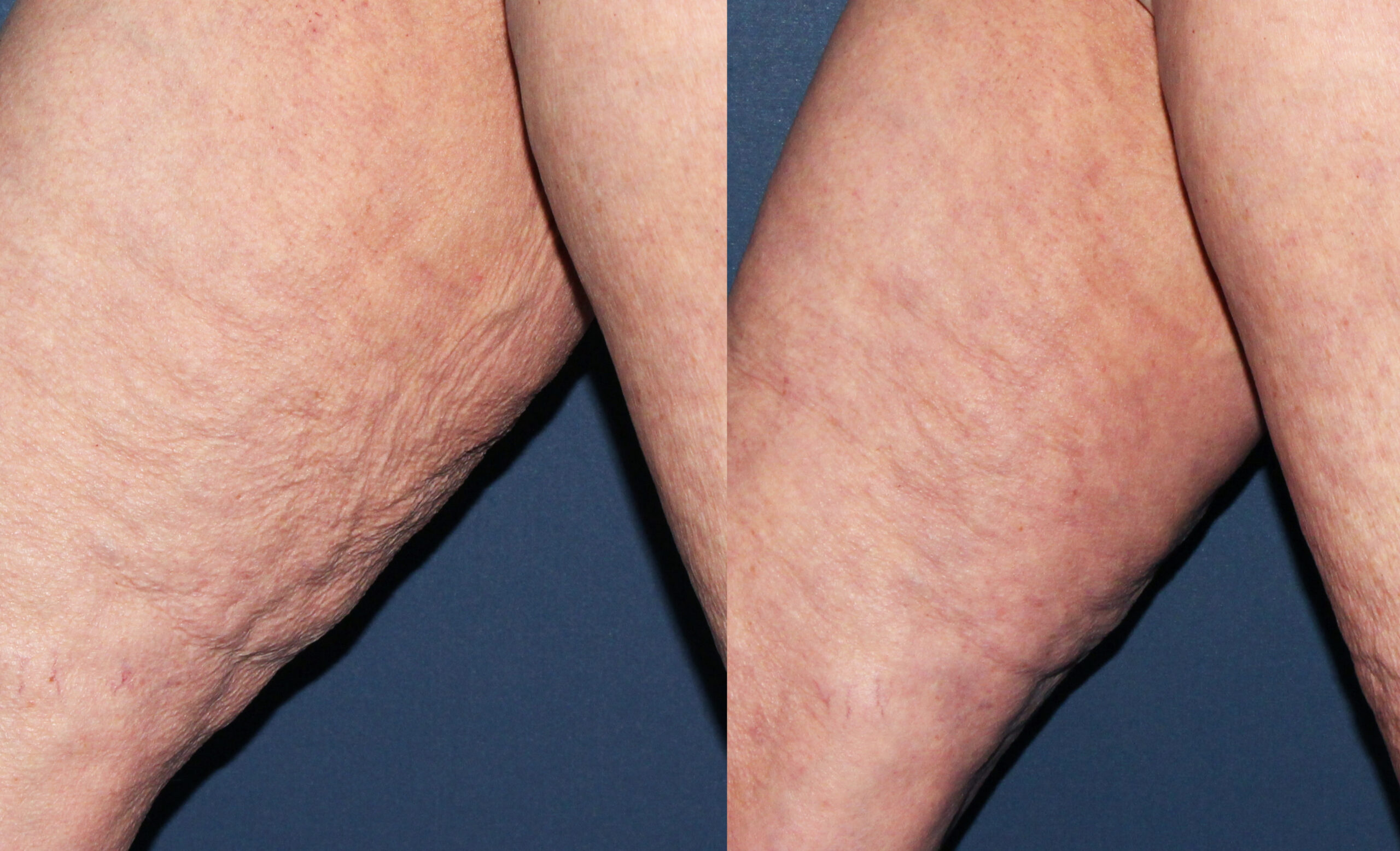 Trattamento di radiofrequenza Thuzzle per la riduzione della cellulite e tonificazione delle gambe