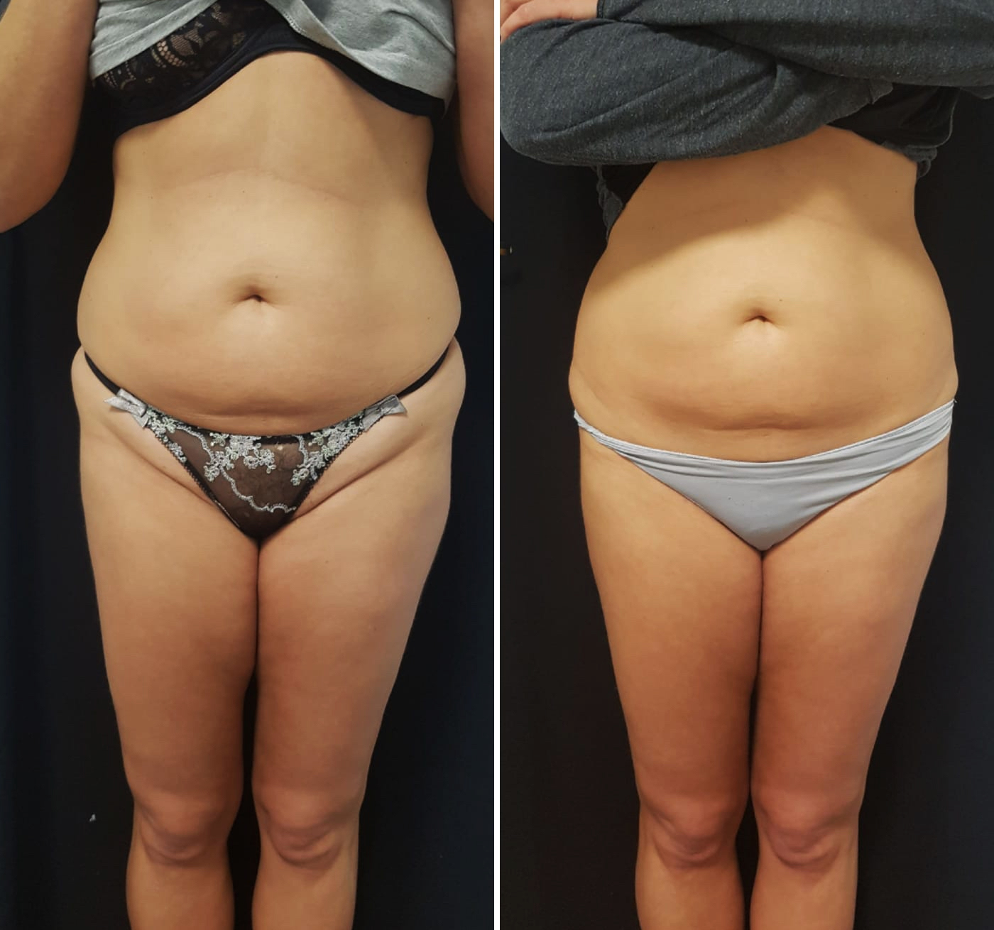 Trattamento di radiofrequenza Thuzzle per la riduzione della cellulite e tonificazione delle gambe